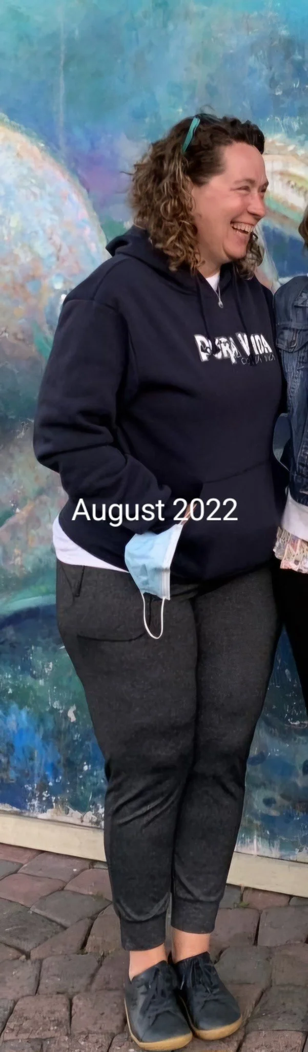 lipedema patient before conservative treatment with Dr. Rodriguez