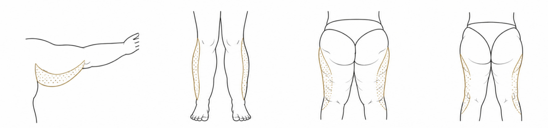 Lipedema Impacts Multiple Areas of the Body