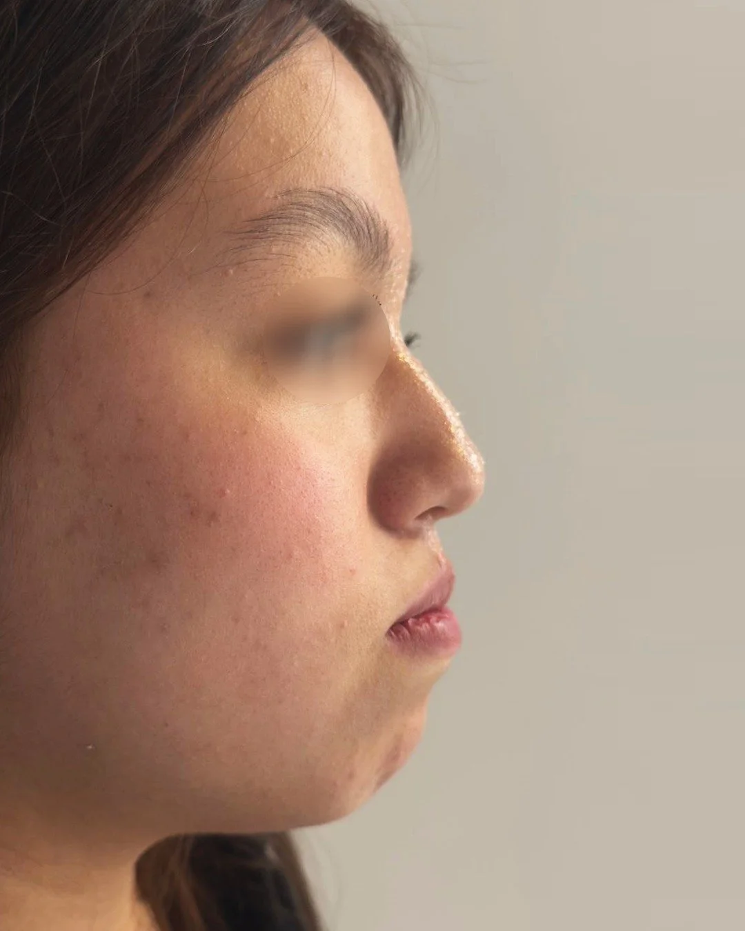 Perfil m&aacute;s limpio, m&aacute;s equilibrado y sin perder su esencia ✨
Rino + ment&oacute;n con una sola jeringa.

#resultadosnaturales #procedimientoseguro #medicinaestetica #armonizacionfacial