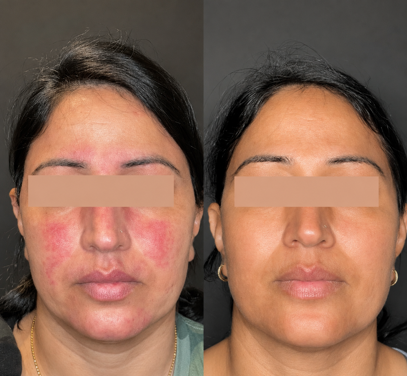 Side-by-side comparison of a woman's face showing skin improvement from redness and acne on the left to clear skin on the right.