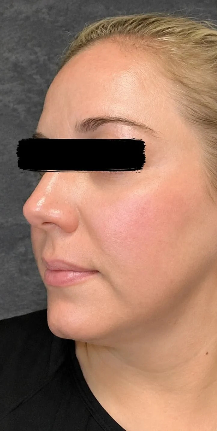 laser treatment at Sarasota Medical Spa in sarasota.jpg