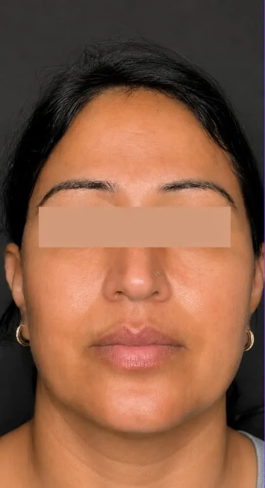 After laser treatment at Sarasota Medical Spa Injections and Co.jpg