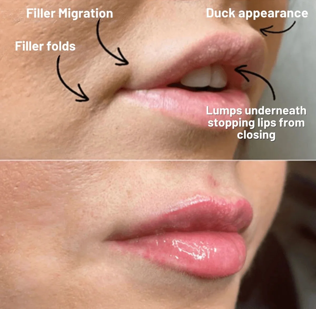 Lip Filler Migration: What It Is, What Causes It &amp; How to Fix It