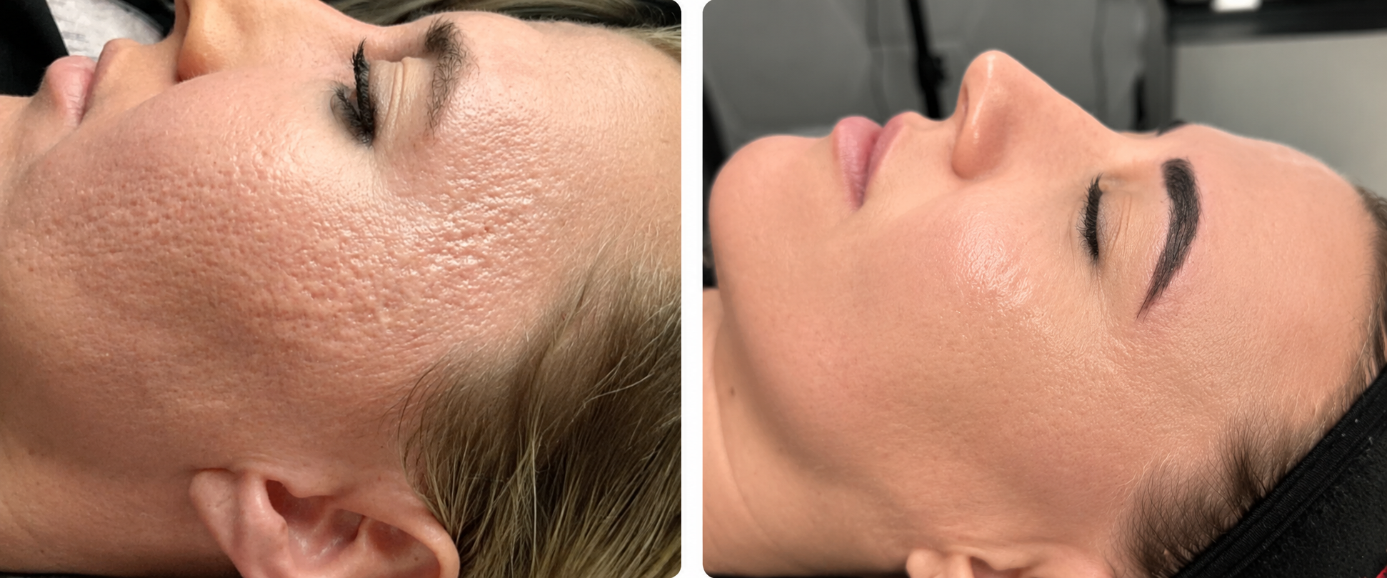 skinpen before and after.png