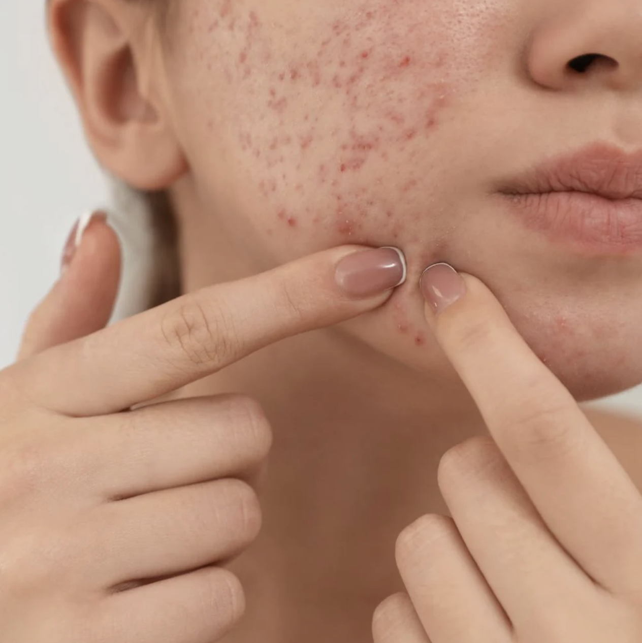 Close-up of a person with acne on their cheek, touching their skin with their fingers.