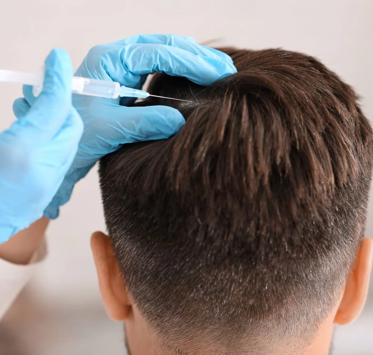 A person receiving a hair injection from a medical professional wearing blue gloves.