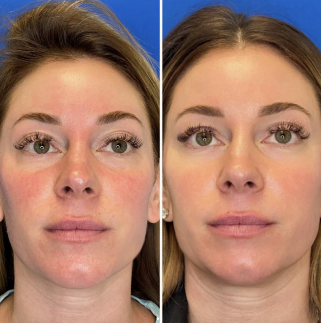 Side-by-side comparison of a woman's face, showing redness and irritation on the left, and clear, smooth skin on the right.
