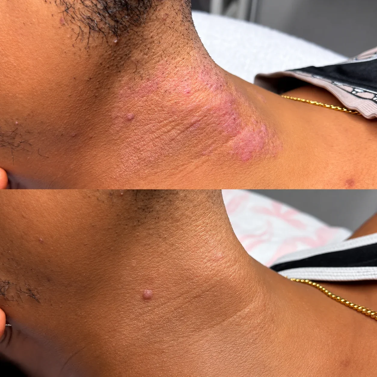 Before and after Aerolase laser treatment on the neck at Injections & Co. in Sarasota