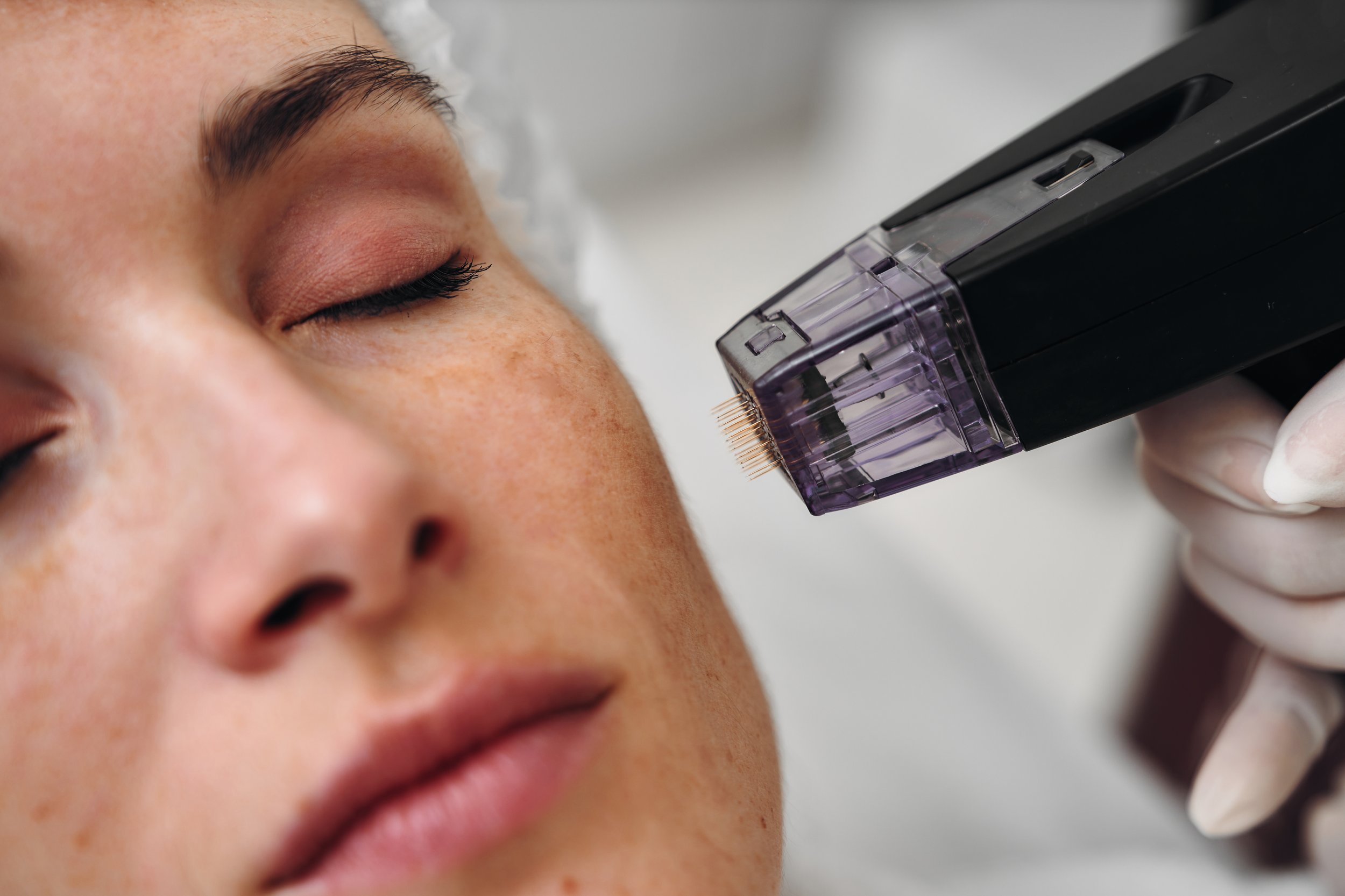Medspa in San Diego, CA, 92106 Microneedling Near Me