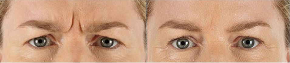 Botox-before-5260089-after-5260090-2-9207780.png