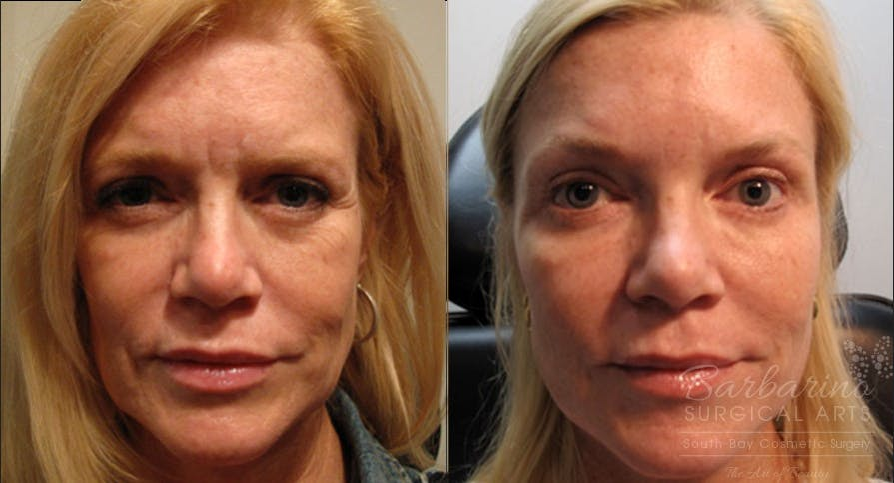 Liquid-Facelift-before-4201265-after-4201266-1-9207781.png