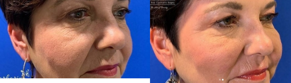 Liquid-Facelift-before-4099842-after-4099843-1-8918040.png