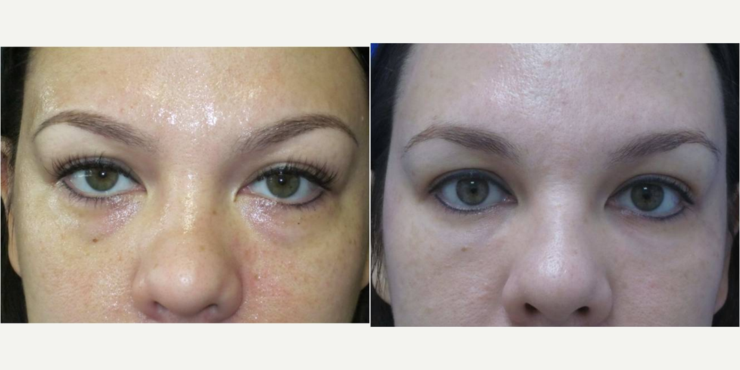 Eyelid-Surgery-before-3667035-after-3667036-1-7496414.webp