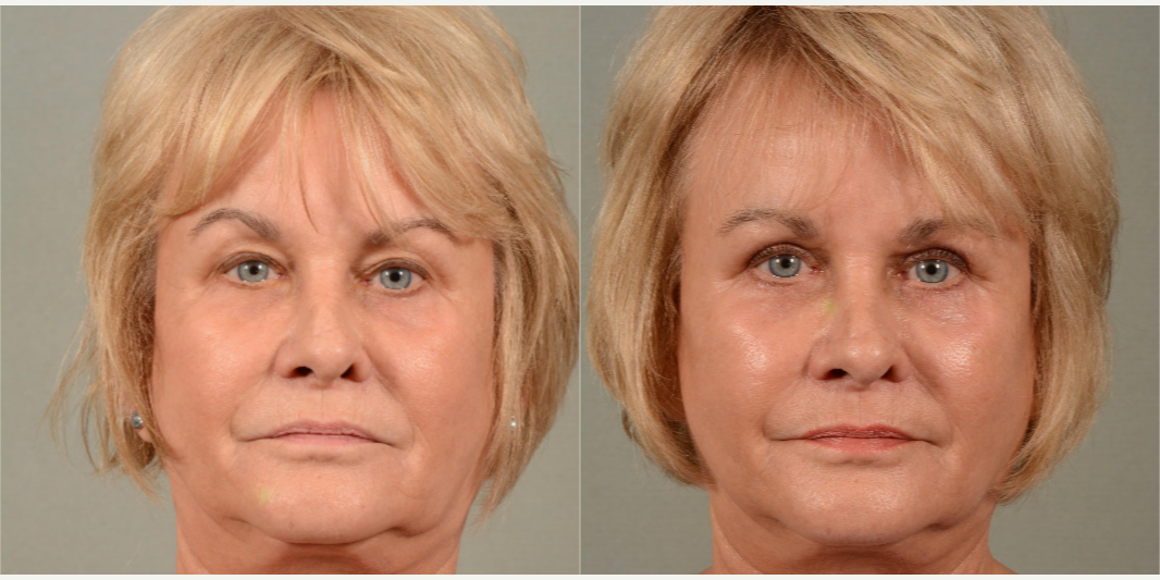 Eyelid-Surgery-before-3877162-after-3877163-1-8181841.webp