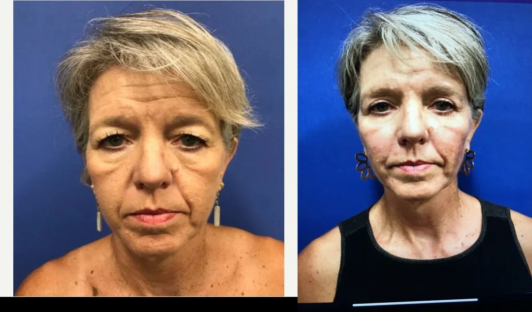 Eyelid-Surgery-before-3878232-after-3878233-3-7656620.webp