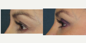Eyelid-Surgery-before-3882277-after-3882278-1-8199144.webp