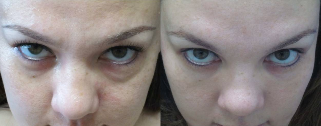 Eyelid-Surgery-before-4196337-after-4196338-3-7496420.webp