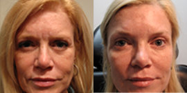 Eyelid-Surgery-before-4361521-after-4361522-3-5030853.webp