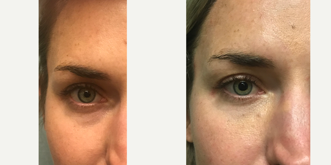 Eyelid-Surgery-before-4361525-after-4361526-2-6642882.webp