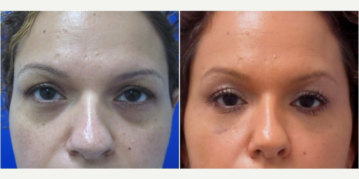Eyelid-Surgery-before-4361529-after-4361530-2-7496399.webp