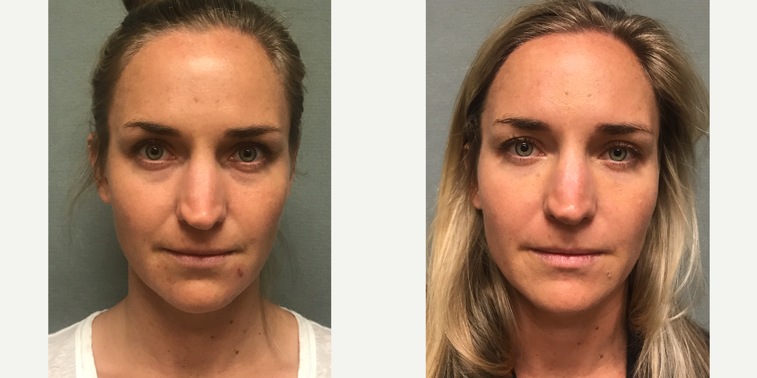 Eyelid-Surgery-before-4361535-after-4361536-3-5677013.webp