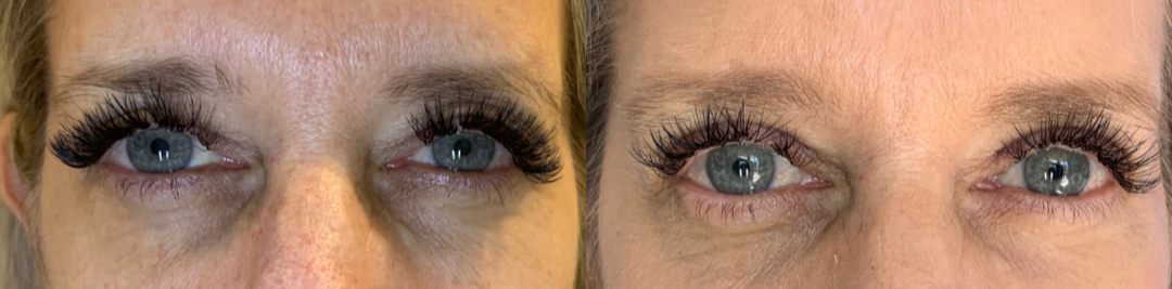 Eyelid-Surgery-before-4440749-after-4440750-1-9760631.webp