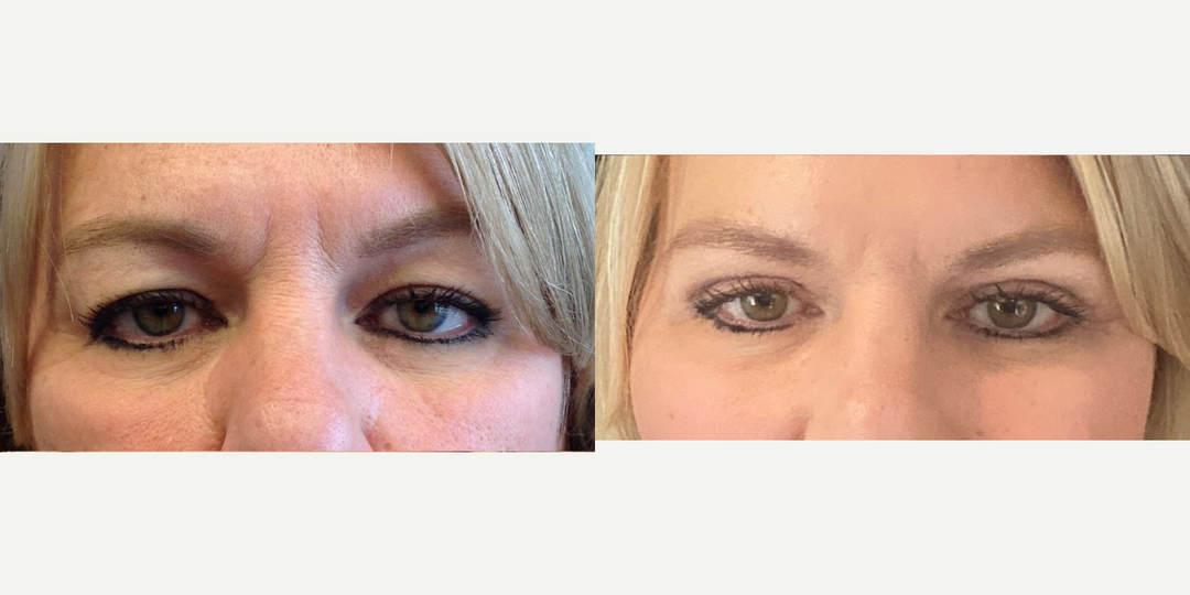 Eyelid-Surgery-before-4640195-after-4640196-1-10508363.webp