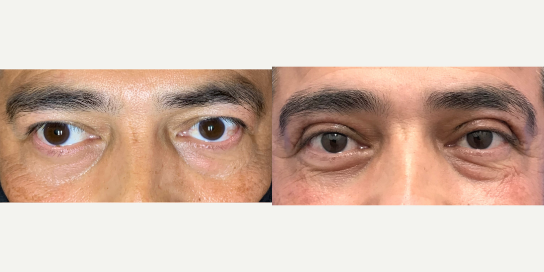 Eyelid-Surgery-before-4720785-after-4720786-1-10806136.webp