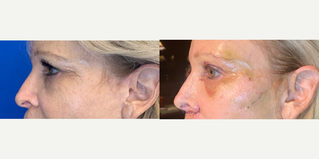 Eyelid-Surgery-before-4801210-after-4801211-1-11106533.webp