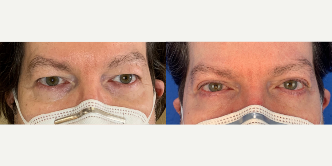 Eyelid-Surgery-before-4874843-after-4874844-1-11365564.webp