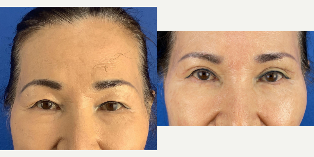 Eyelid-Surgery-before-5024771-after-5024772-0-11775562.webp