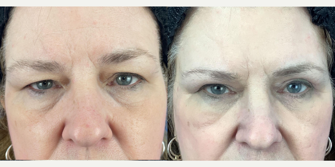Eyelid-Surgery-before-5081757-after-5081758-1-11913599.webp