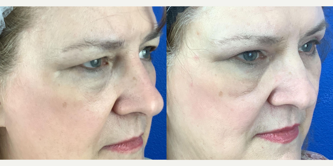 Eyelid-Surgery-before-5081759-after-5081760-1-11913598.webp