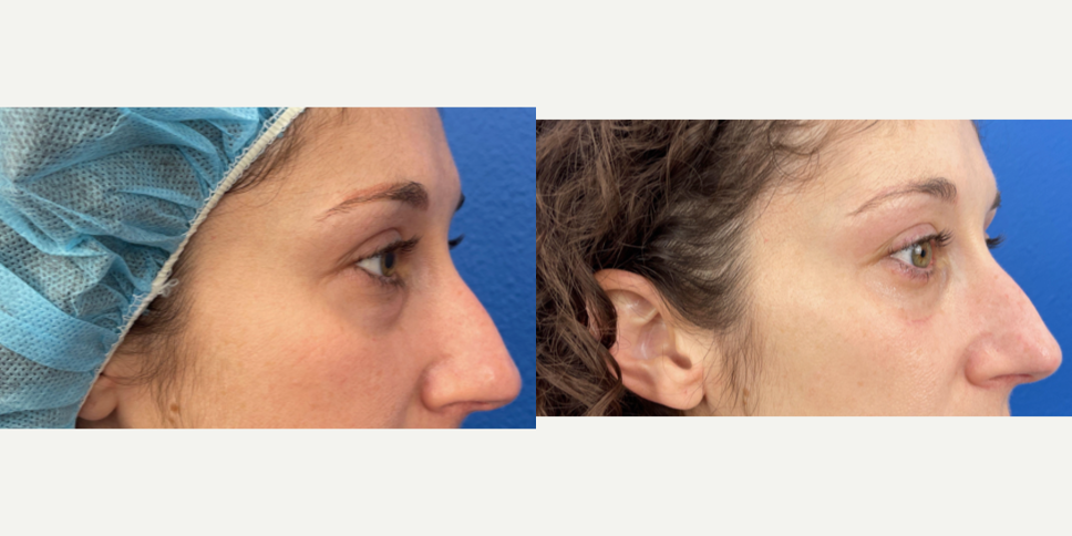 Eyelid-Surgery-before-5310345-after-5310346-1-12342336.webp