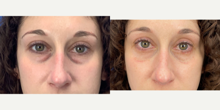 Eyelid-Surgery-before-5310347-after-5310348-1-12342335.webp