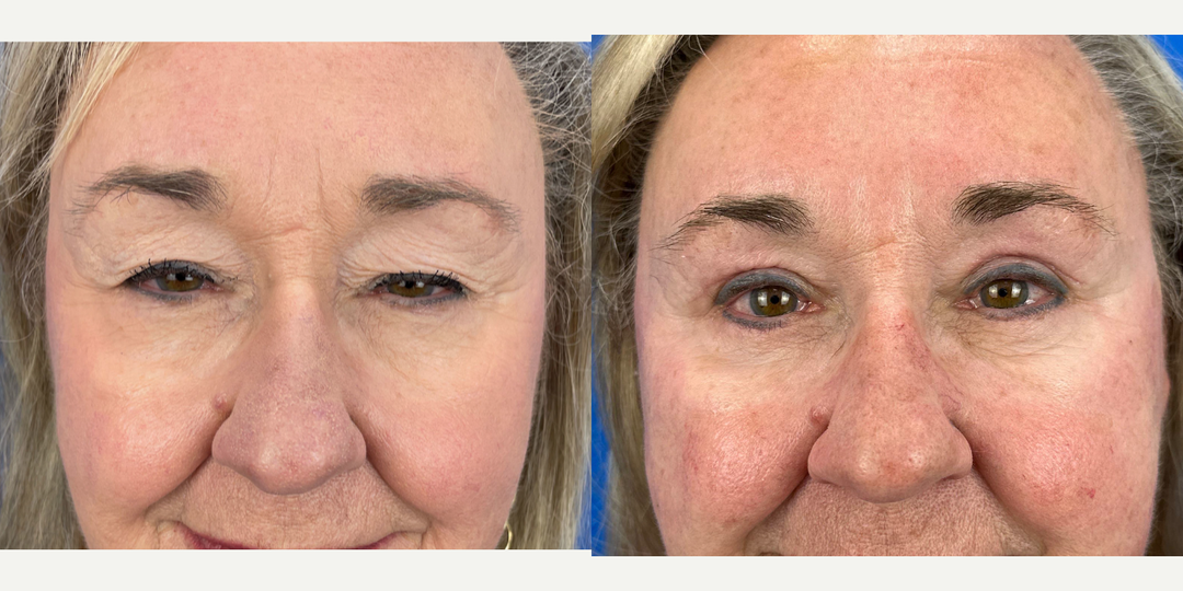 Eyelid-Surgery-before-5654532-after-5654533-1-12780815.webp