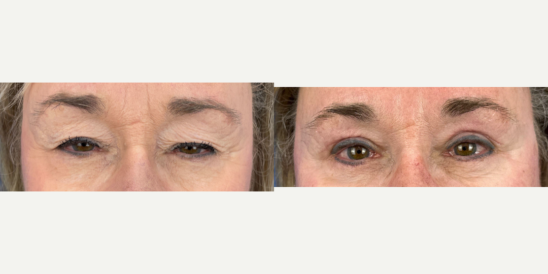 Eyelid-Surgery-before-5654562-after-5654563-1-12780814.webp