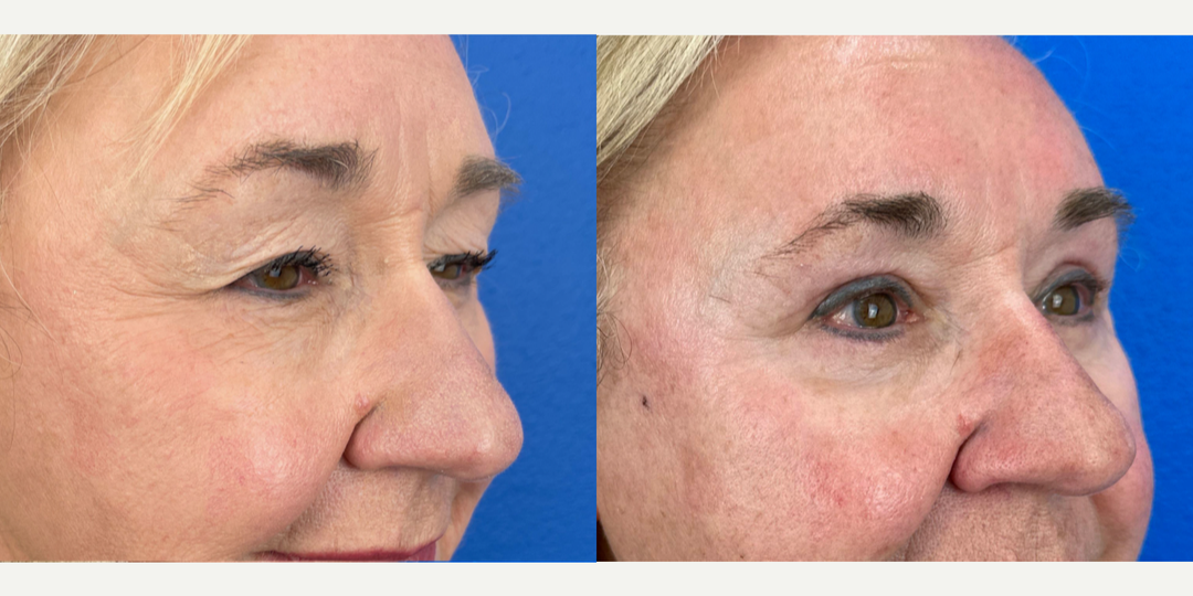 Eyelid-Surgery-before-5654588-after-5654589-1-12780818.webp