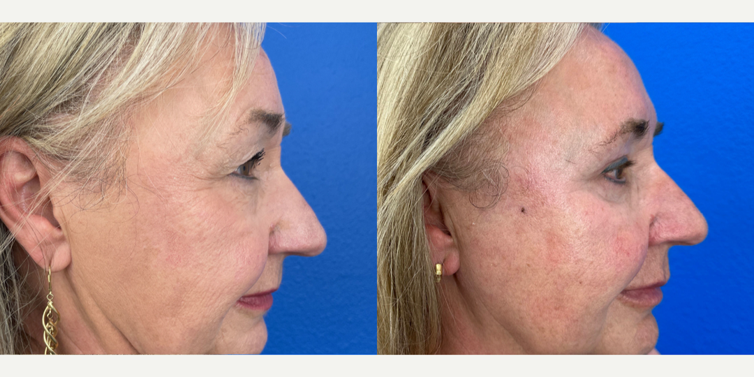 Eyelid-Surgery-before-5654610-after-5654611-1-12780823.webp
