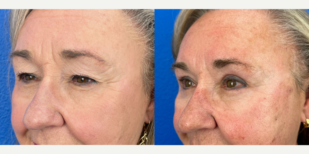 Eyelid-Surgery-before-5654842-after-5654843-1-12780824.webp