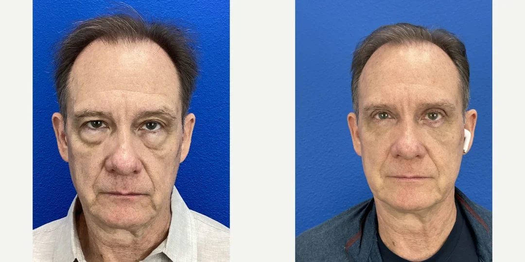 Eyelid-Surgery-before-8061814-after-8061815-2-13656396.webp
