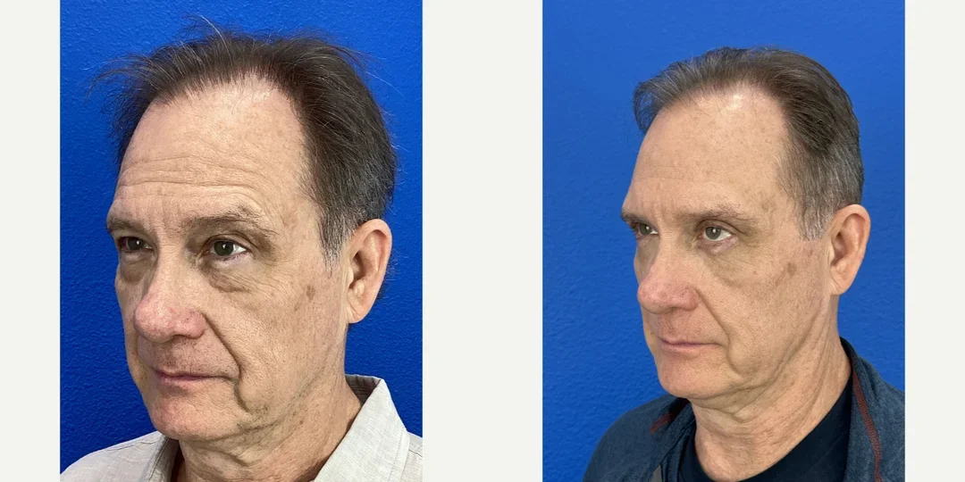 Eyelid-Surgery-before-8061816-after-8061817-1-13656394.webp