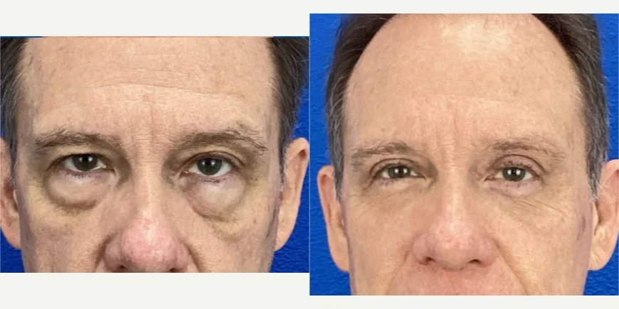 Eyelid-Surgery-before-8114277-after-8114278-1-13702958.webp