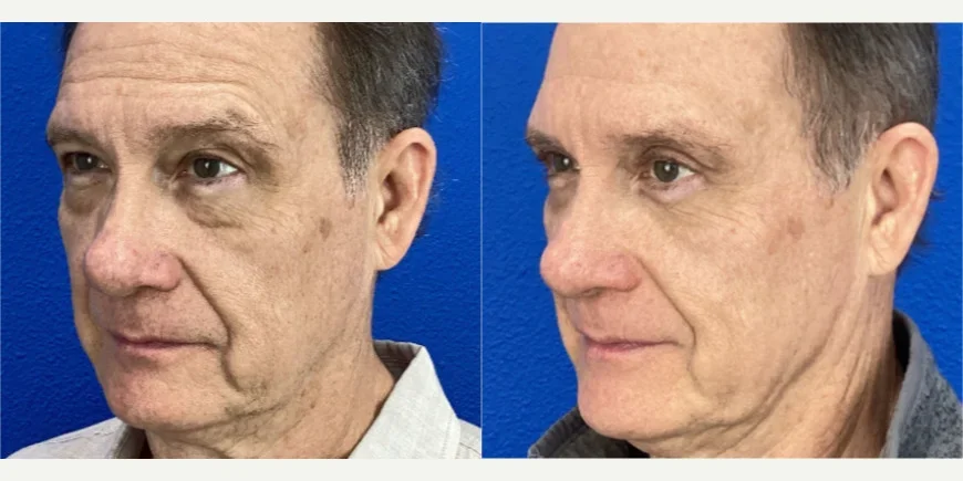 Eyelid-Surgery-before-8114281-after-8114282-1-13702961.webp