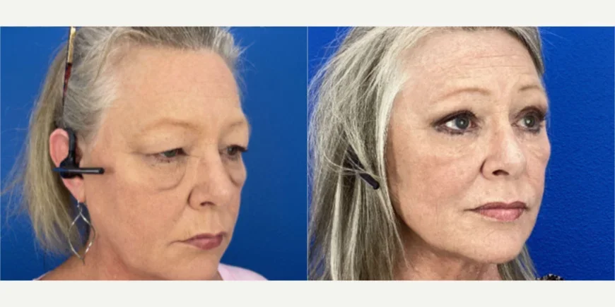 Eyelid-Surgery-before-8136054-after-8136055-1-13729627.webp