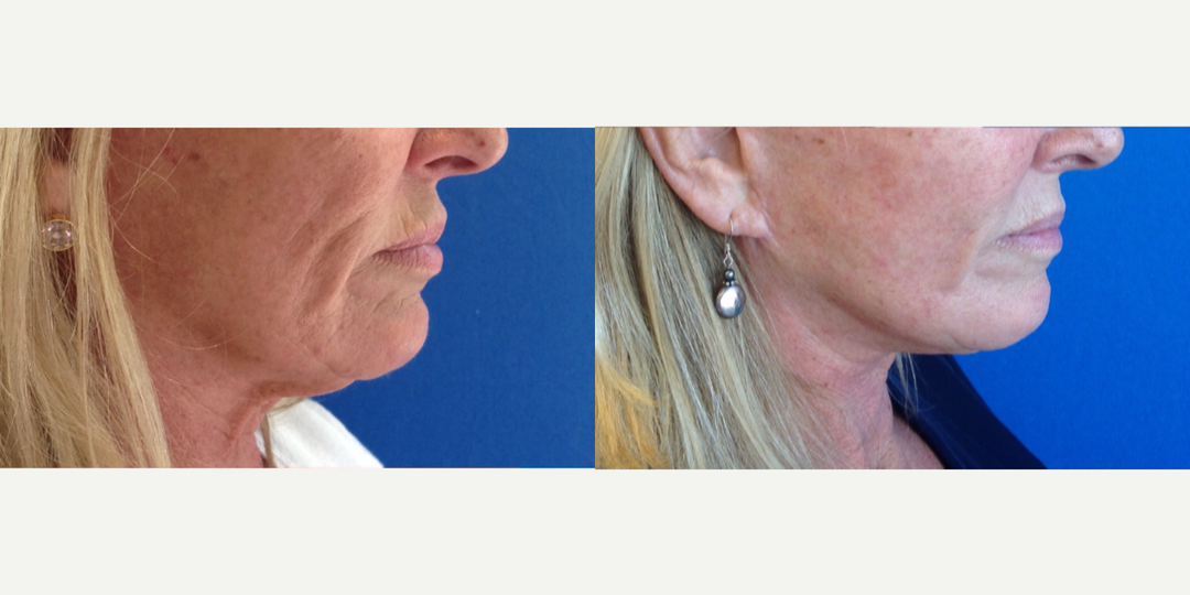  65-74 year old woman treated with Neck Lift as well as Facelift and Chemical Peel, shown 6 months post op. 