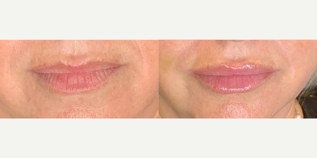 Lip-Fillers-before-4801206-after-4801207-1-11106494.webp