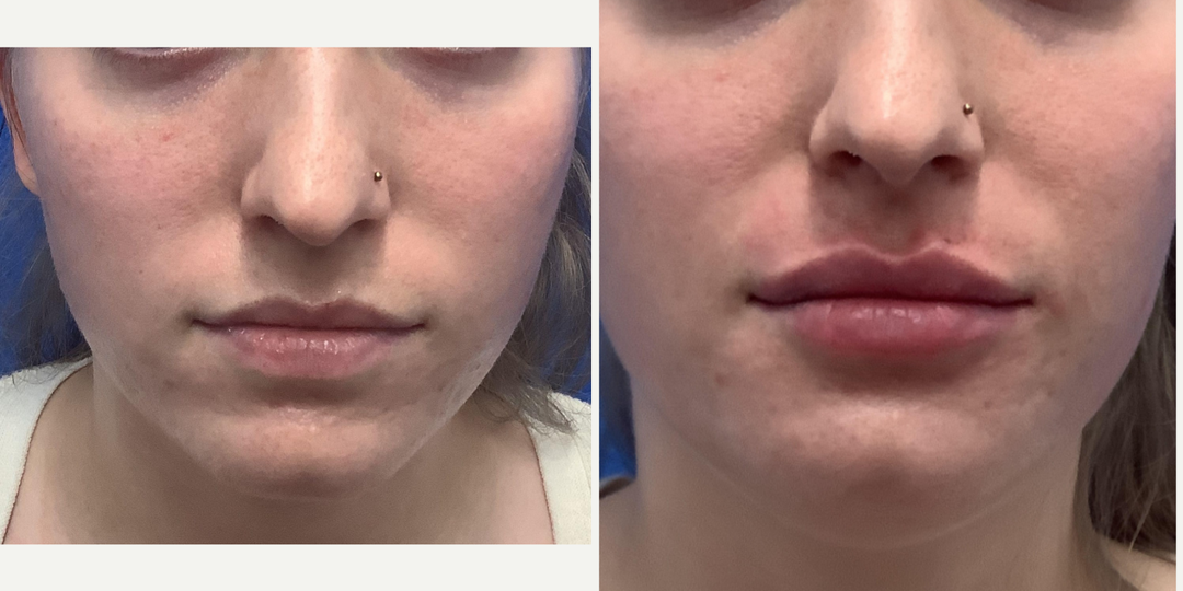 Lip-Fillers-before-4850118-after-4850119-2-11282666.webp