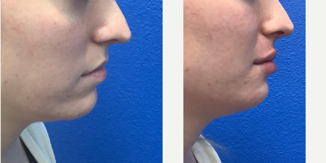Lip-Fillers-before-4850142-after-4850143-1-11282774.webp