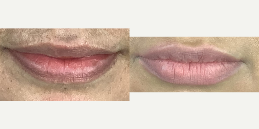 Lip-Fillers-before-4874847-after-4874848-1-11365582.webp